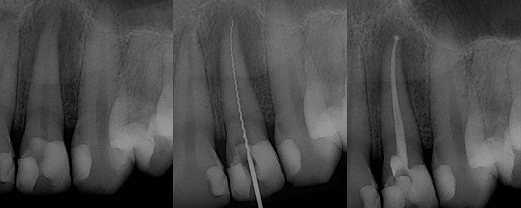 Root Canal West Malling Tooth Infection Endodontics Kent